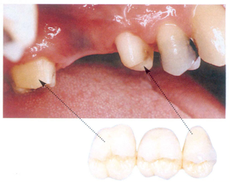 замещение отсутствующего зуба мостовидным протезом